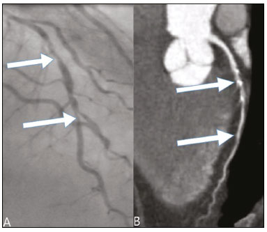 Lavoisier - Teste ergométrico, cintilografia miocárdica, ecocardiograma,  holter, mapa, eletrocardiograma, angiotomografia coronariana, escore de  cálcio e ressonância cardíaca. Aqui no Lavoisier Angélica I você encontra  diversos de exames cardiológicos