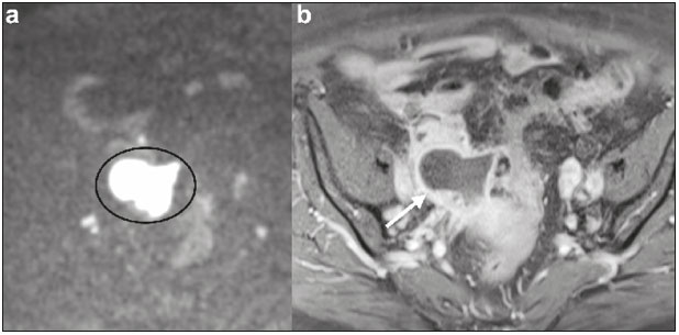 Comparison of SI with b value of 1000 s/mm2 in malignant and benign