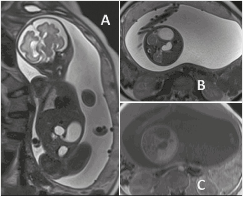 Radiologia Brasileira - Avaliação do abdome fetal por ressonância magnética.  Parte 1: malformações da cavidade abdominal