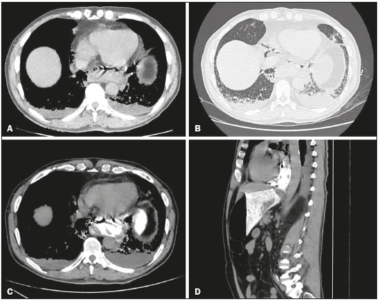 tomografia pulmonar com contraste tomografia pulmonar com contraste