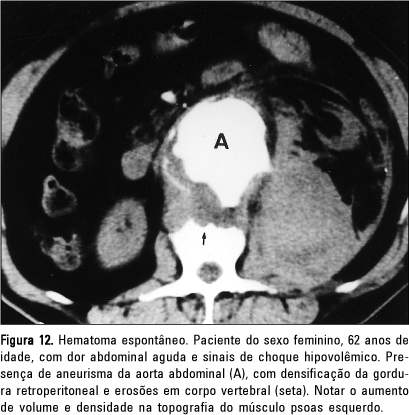 Imagens oriundas de tomografia microscópica mostrando rupturas nos