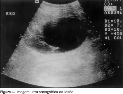 PDF) ABORDAGEM MINIMAMENTE INVASIVA COMBINADA: RESSECÇÃO DE CISTO  MESENTÉRICO GIGANTE E CISTO OVARIANO E OOFOROPLASTIA À ESQUERDA COM  RESSECÇÃO DE TUMOR DE OVÁRIO À DIREITA POR MINILAPAROSCOPIA: 2 RELATOS DE  CASO