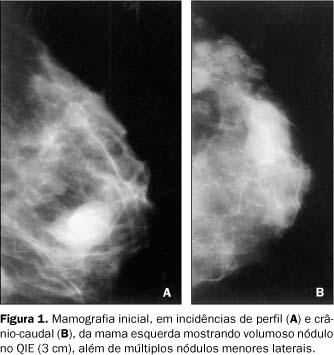 papiloma intraductal de mama tratamento