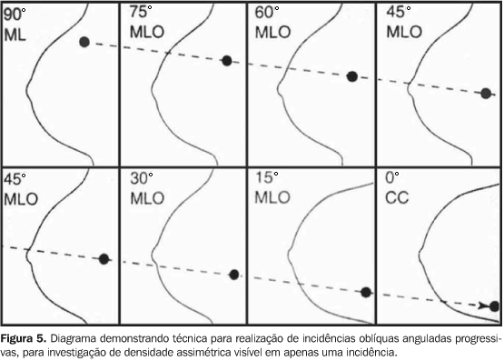 Câncer de mama multifocal/multicêntrico: Perfil clínico