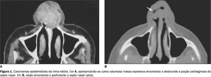 papiloma nasal tomografia