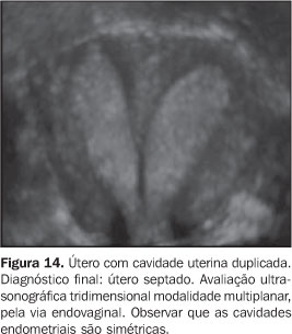 Malformações uterinas: como ocorrem?