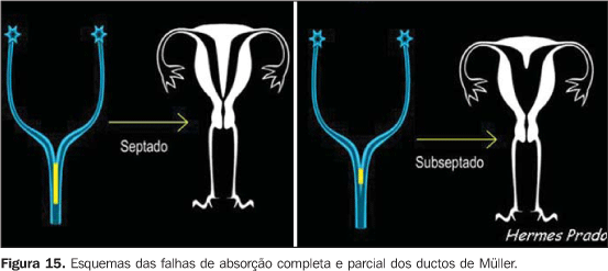 Malformações uterinas: como ocorrem?