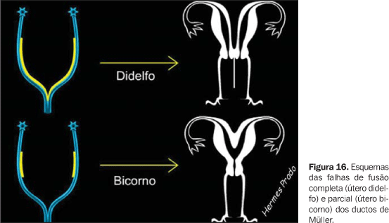 Malformações uterinas: como ocorrem?