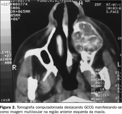 Distribuição dos tipos ósseos encontrados na maxila e na mandíbula