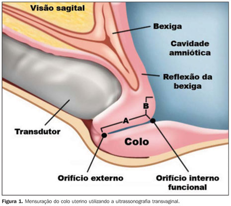 6 Dias De Atraso E Teste Negativo Colo Do Utero Fechado