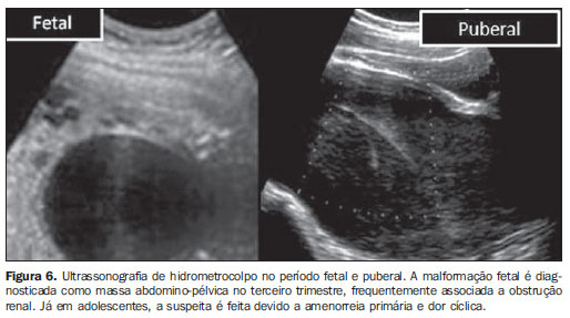 Ultrassonografia pélvica