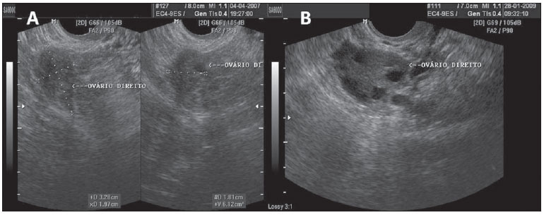 Ecografia transvaginal mostrando ovário de aspecto normal, com a