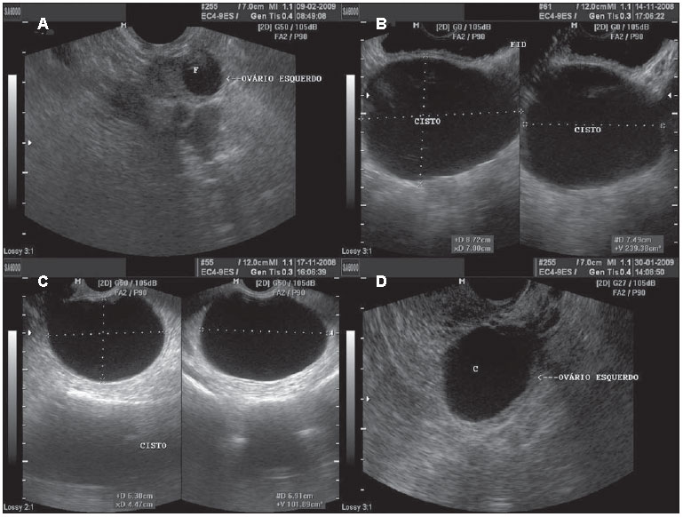 functional cyst