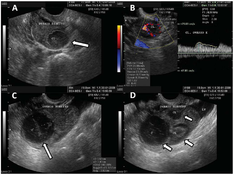 Teratoma de ovário pode se tornar câncer?