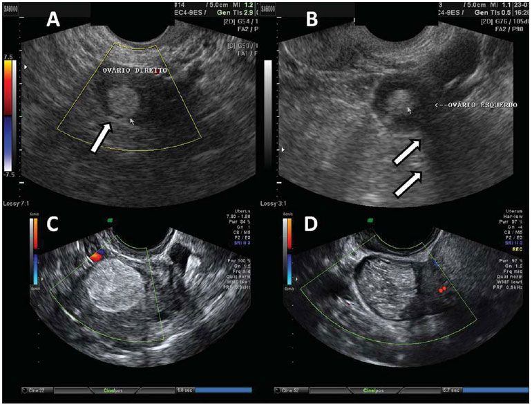 Meu tumor TERATOMA voltou novamente após três meses da cirurgia