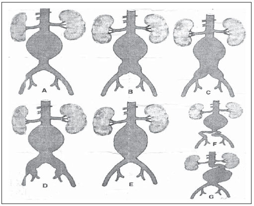 Modelo anatômico de aneurisma da aorta abdominal - 021 series