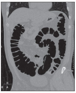 Bowel Distention