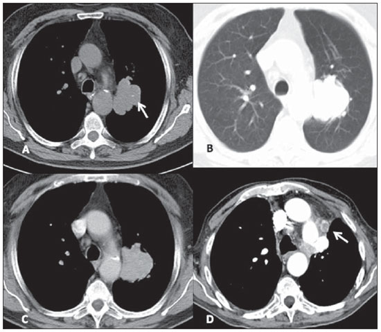 Tumorile pulmonare neuroendocrine(TNE)
