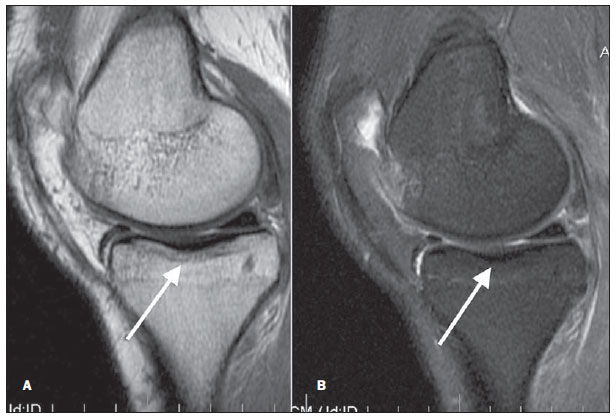 tratamentul osteocondrozei cu medicamente nesteroidiene