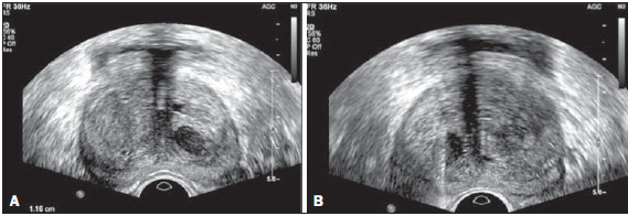 ecografia prostata adenoma