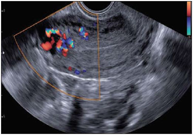 Featured image of post Gravidez Molar Imagens - As células do embrião formam sacos de líquidos.